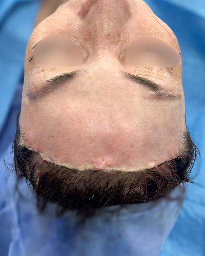 Forehead Reduction Before & After Patient #2848