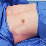 Pectoral Implants Before & After Patient #2849