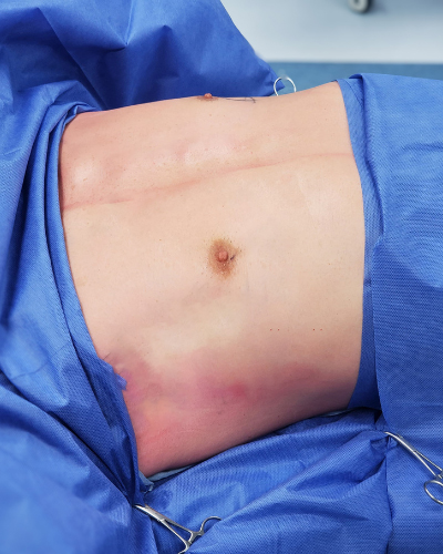 Pectoral Implants Before & After Patient #2849