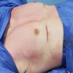 Pectoral Implants Before & After Patient #2849
