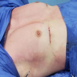 Pectoral Implants Before & After Patient #2849