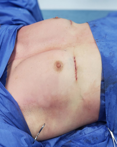 Pectoral Implants Before & After Patient #2849