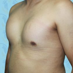 Pectoral Implants Before & After Patient #2850