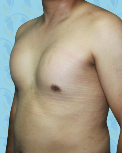 Pectoral Implants Before & After Patient #2850