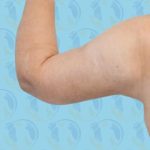 Brachioplasty Before & After Patient #2894