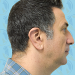 Facelift Before & After Patient #2895