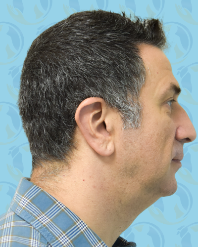 Facelift Before & After Patient #2895