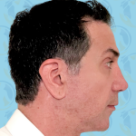 Facelift Before & After Patient #2895