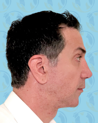 Facelift Before & After Patient #2895