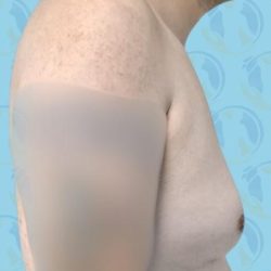 Gynecomastia Before & After Patient #2903