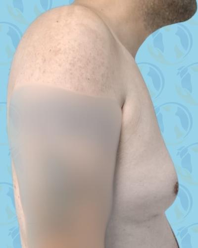 Gynecomastia Before & After Patient #2903