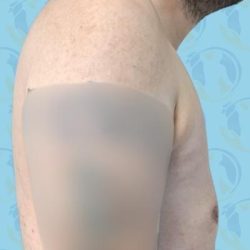 Gynecomastia Before & After Patient #2903