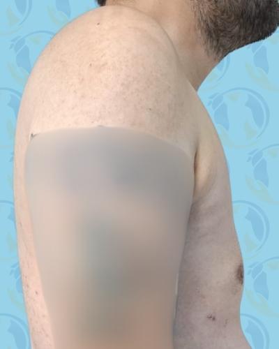 Gynecomastia Before & After Patient #2903