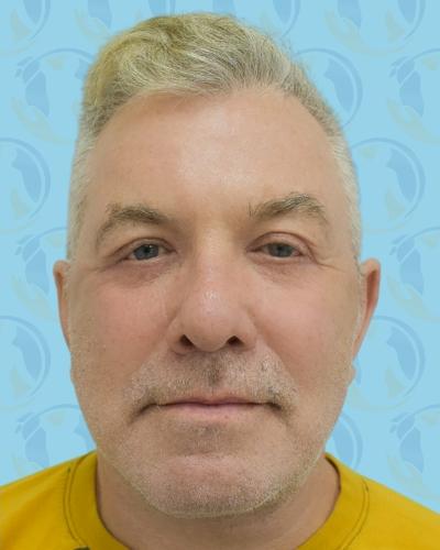 Facelift Before & After Patient #2896