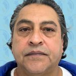 Facelift Before & After Patient #2897