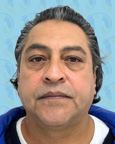 Facelift Before & After Patient #2897
