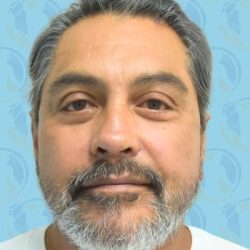 Facelift Before & After Patient #2897