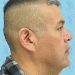 Facelift Before & After Patient #2898