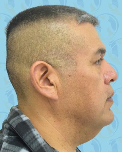 Facelift Before & After Patient #2898