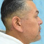 Facelift Before & After Patient #2898