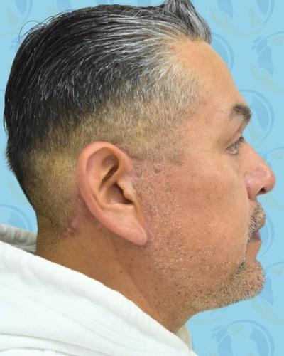 Facelift Before & After Patient #2898