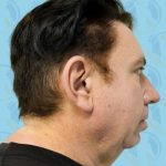 Facelift Before & After Patient #2899