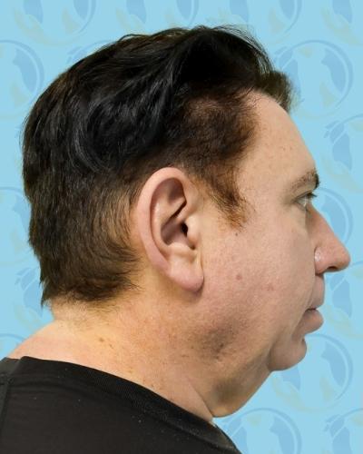 Facelift Before & After Patient #2899