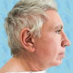 Facelift Before & After Patient #2899
