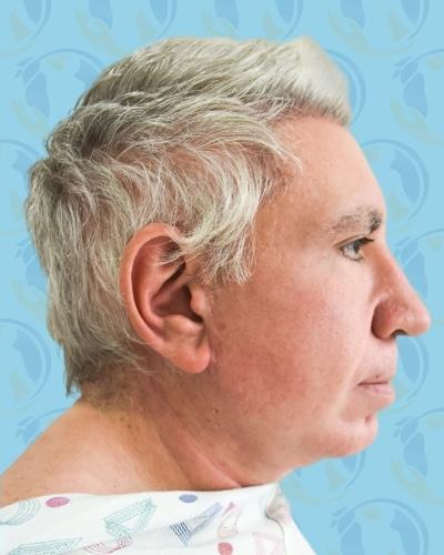Facelift Before & After Patient #2899