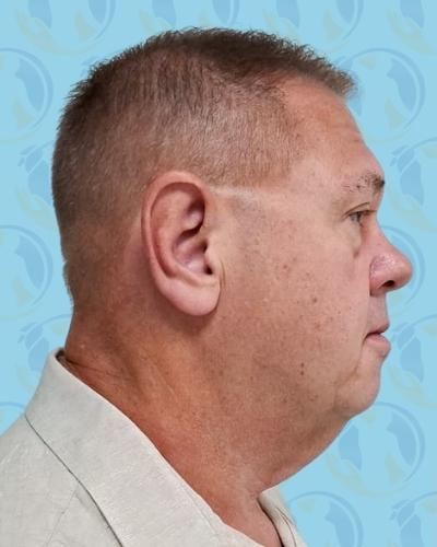 Facelift Before & After Patient #2901