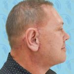 Facelift Before & After Patient #2901
