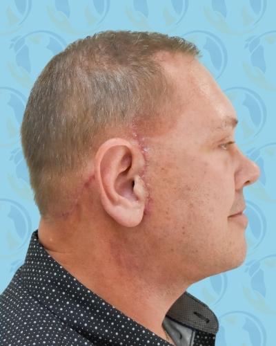 Facelift Before & After Patient #2901