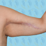 Brachioplasty Before & After Patient #2841