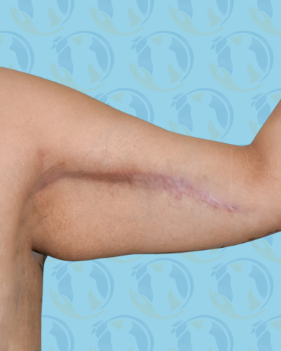 Brachioplasty Before & After Patient #2841