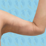 Brachioplasty Before & After Patient #2841