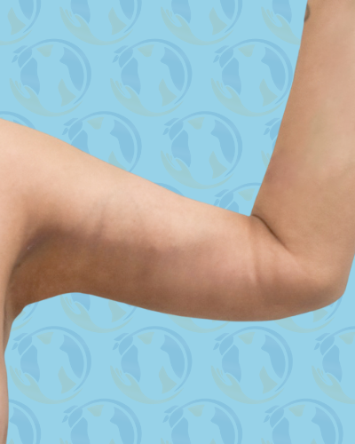 Brachioplasty Before & After Patient #2841