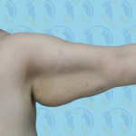 Brachioplasty Before & After Patient #2936