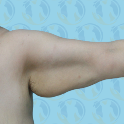 Brachioplasty Before & After Patient #2936