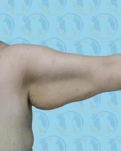Brachioplasty Before & After Patient #2936