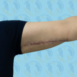 Brachioplasty Before & After Patient #2936