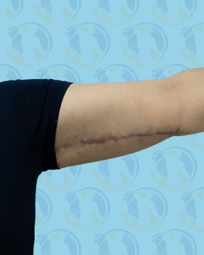 Brachioplasty Before & After Patient #2936