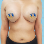 Breast Implant Before & After Patient #2940