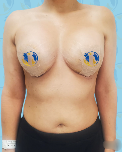 Breast Implant Before & After Patient #2940