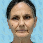 Facelift Before & After Patient #2941