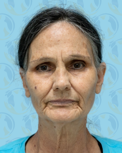 Facelift Before & After Patient #2941