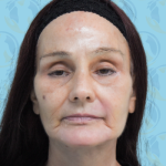 Facelift Before & After Patient #2941