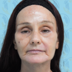 Facelift Before & After Patient #2941