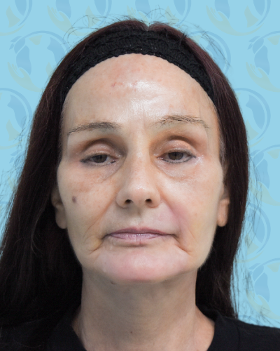 Facelift Before & After Patient #2941