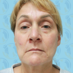 Facelift Before & After Patient #2943