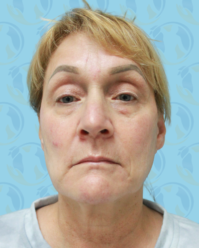 Facelift Before & After Patient #2943